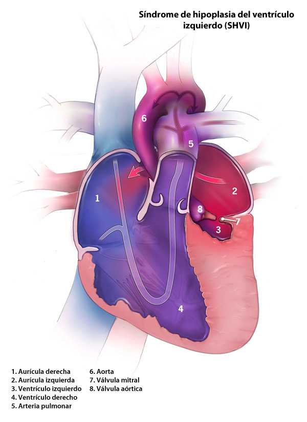 	Hypoplastic Left Heart Syndrome