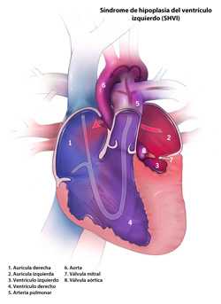 	Hypoplastic Left Heart Syndrome