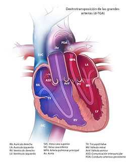 	Transposition of the Great Arteries