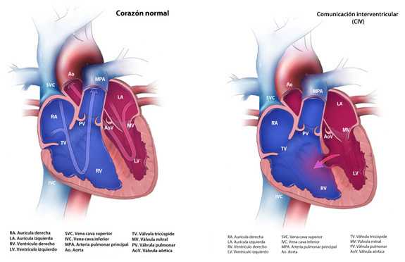 	Ventricular Septal Defect (VSD)