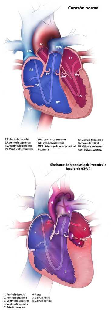 	Hypoplastic Left Heart Syndrome