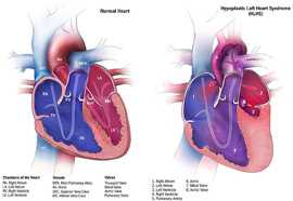 	Imagen del sÃ­ndrome de corazÃ³n izquierdo hipoplÃ¡sico y de un corazÃ³n normal 