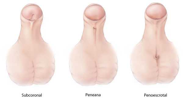 	Types of Hypospadias - Subcoronal, Midshaft, and Penoscrotal