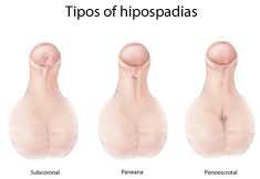 	Types of Hypospadias - Subcoronal, Midshaft, and Penoscrotal