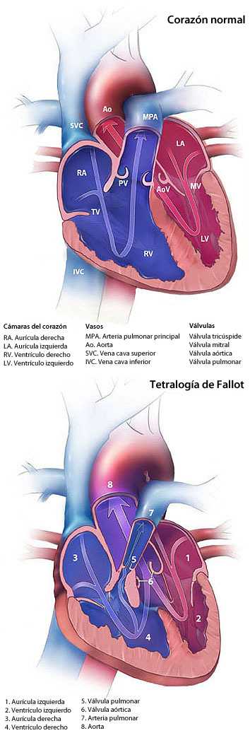 	TetralogÃ­a de Fallot Diagrama