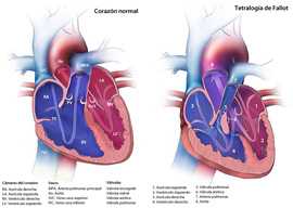 	TetralogÃ­a de Fallot Diagrama