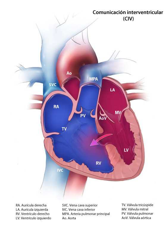 	Ventricular Septal Defect