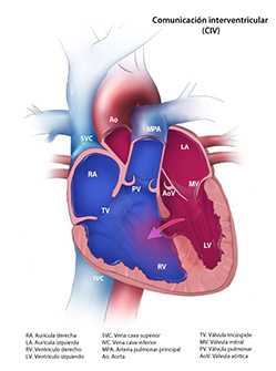 	Ventricular Septal Defect