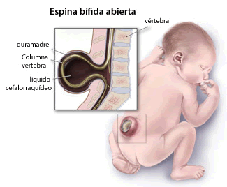 Diagrama de la espina bífida (espina bífida abierta) 