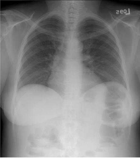 Figure 4a. A digital radiograph of the chest taken with a general purpose CR screen (GP screen, Eastman Kodak Company) is illustrated using no display processing. To display the wide range of raw image values, a wide latitude grayscale rendition has been used that results in poor tissue contrast.