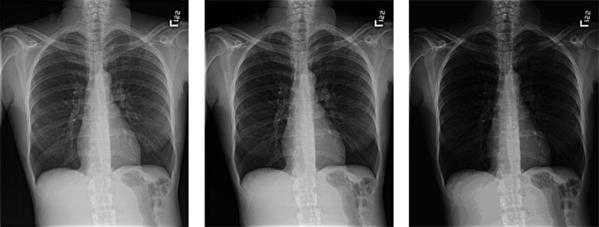 Figure 7. The appearance of the same image display with different display luminance ratios is simulated. At the left is the image presented with the desired luminance ratio. As the ratio is increased from left to right, the tissue structures in the lung become dark and contrast is not visible. 