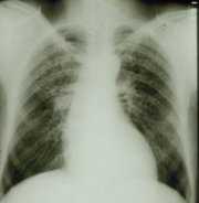 	Radiograph showing Simple Coal Workers Pneumoconiosis