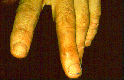 	SLIDE 38 - Chrome hole, fingers