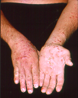 	SLIDE 116 - Irritant Contact Dermatitis from Fiber Glass