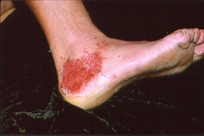 	SLIDE 118 - Irritant Contact Dermatitis from Fiber Glass