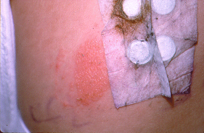 	SLIDE 120 - Positive Patch Test