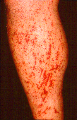 	SLIDE 124 - Phytophotodermatitis