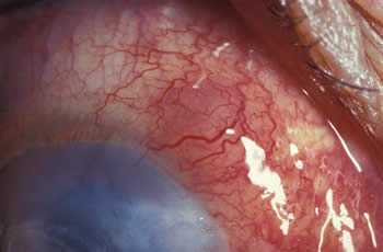 Nodular scleritis