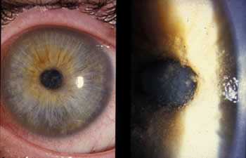 Early epithelial stage of infection