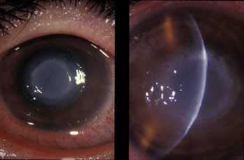 Early, central stromal inflammation