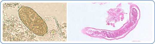 Capillariasis