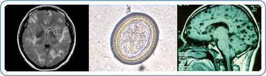 Center is an image of a Taenia egg at a high magnification of 400x. When consumed by humans Taenia eggs can lead to Cysticercosis, and also a serious condition known as neurocysticercosis. On the left and right are X-Ray images of humans with neurocysticercosis. The darker regions are cysts in the brain of the patient. Credit (L to R): Public Health Image Library, Westchester Medical Center, The Cysticercosis Working Group in Peru.