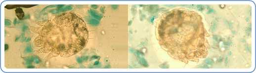 Sarcoptes scabiei mites in a skin scraping, stained with lactophenol cotton-blue