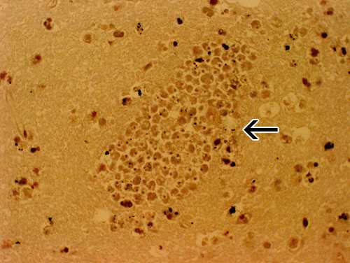 A section of the brain from a PAM patient stained with hemotoxylin and eosin showing a large cluster of Naegleria fowleri trophozoites surrounding capillaries. Magnification: 400x.