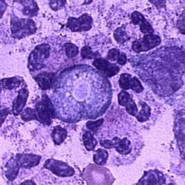 Trophozoite of Naegleria fowleri in CSF, stained with H&E.