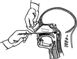 Collecting a Nasopharyngeal Swab Clinical Specimen in sitting position