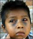 Child with broken blood vessels in eyes and bruising on face due to pertussis coughing.