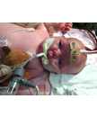 Image three - Infant being treated for severe pertussis infection