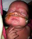 Image two - Infant being treated for severe pertussis infection