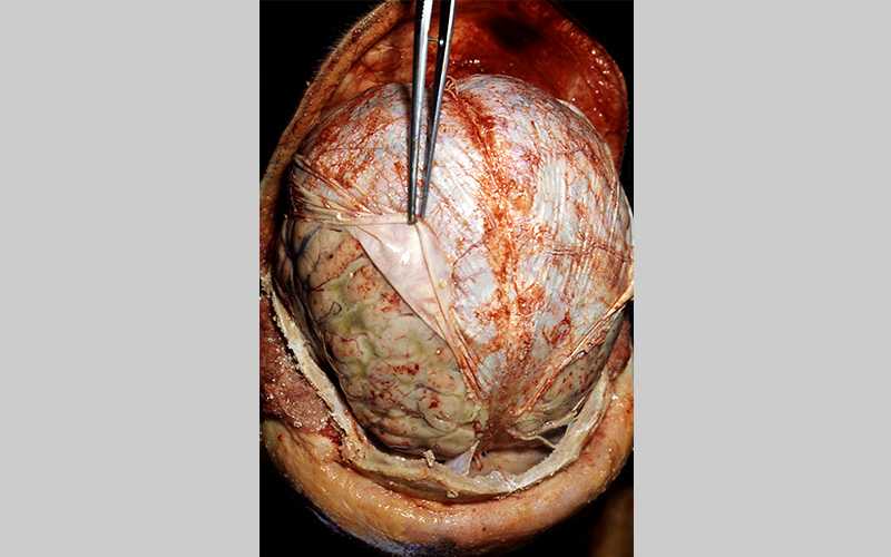 Pneumococcal meningitis in an alcoholic.