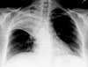 chest x-ray