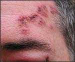 Fresh Shingles; facial rash with swollen eyelids.