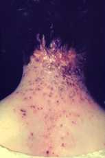 This photograph displays the nape of a neck of a woman with eczema vaccinatum. This patient had a history of eczema. Source: CDC.