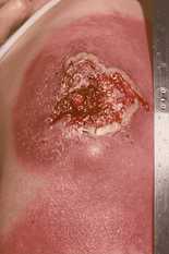 The initial vaccination site of a patient with progressive vaccinia. Source: CDC/Dr. Clement R. Boughton.