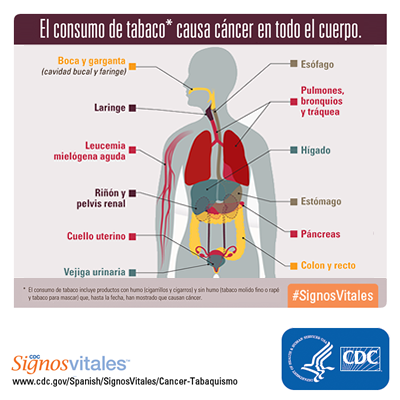 El consumo de tabaco* causa cáncer en todo el cuerpo, incluyendo la boca y garganta (cavidad oral y faringe); laringe; esófago; pulmones, bronquios y tráquea; estómago; riñón y pelvis renal; páncreas; hígado; vejiga urinaria; cuello uterino; colon y recto; y leucemia mielógena aguda. El consumo de tabaco incluye productos con humo (cigarrillos y cigarros) y sin humo (tabaco molido fino o rapé y tabaco para mascar) que, hasta la fecha, han mostrado que causan cáncer.