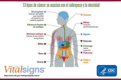 Infografía: 13 tipos de cáncer se asocian con el sobrepeso y la obesidad.