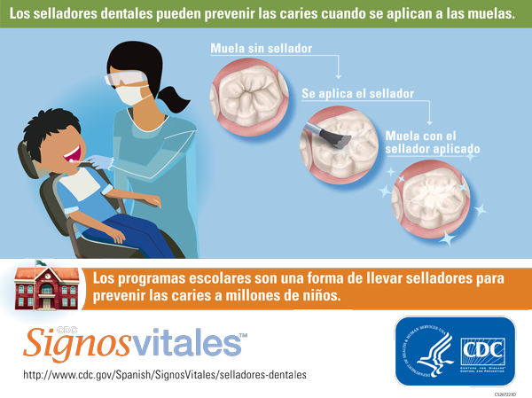 Infografía: Los selladores dentales pueden prevenir las caries cuando se aplican a las muelas.