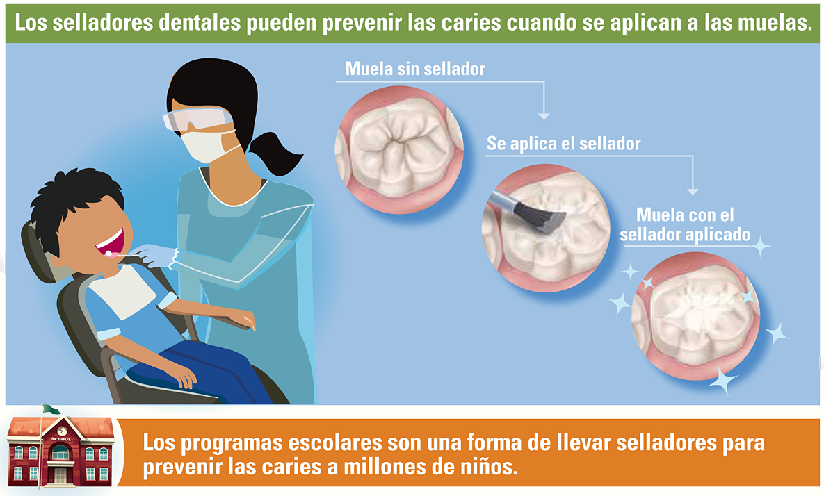 Infografía: Los selladores dentales pueden prevenir las caries cuando se aplican a las muelas.