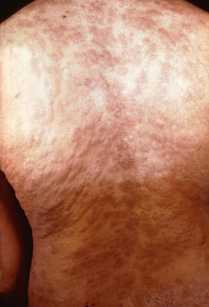 syphilis rash on back