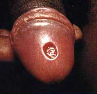 Primary stage syphilis sore (chancre) on glans (head) of the penis.