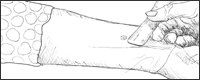 Drawing showing measurement of TB skin test where the tuberculin was injected. 