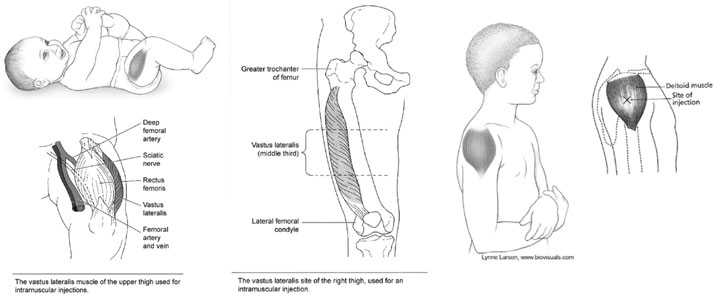 images of baby and vastus laterlis muscle and site of the upper and right thigh used for intramuscular injections. image of youth and deltoid muscle site of injection. Lynne Larson: www.biovisuals.com