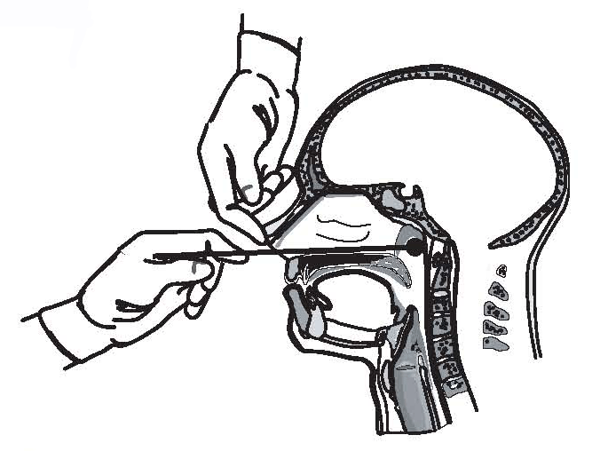 Figure 1: Proper technique for obtaining a nasopharyngeal specimen for isolation of B. pertussis