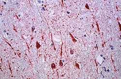 Nipah virus infection in human central nervous system tissue specimen, credit to CDC PHIL