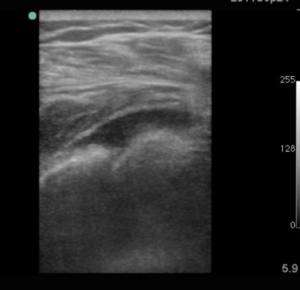 Joint effusion