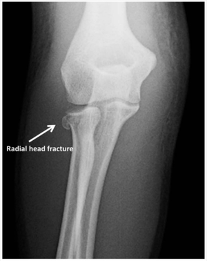 Radial Head Fracture.png
